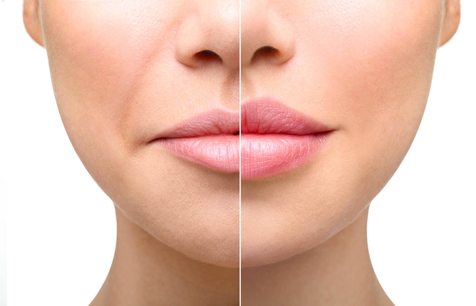-37% на увеличения губ <br> препаратом Hyaluform lips <br> 1 мл - 8 500 руб. вместо 13 500 руб.